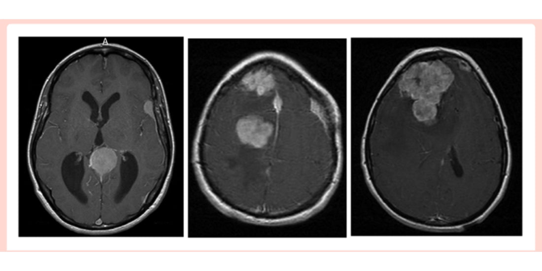 Synthetic Progesterone & Meningioma