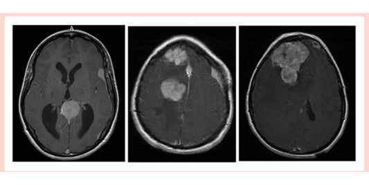 Synthetic Progesterone & Meningioma