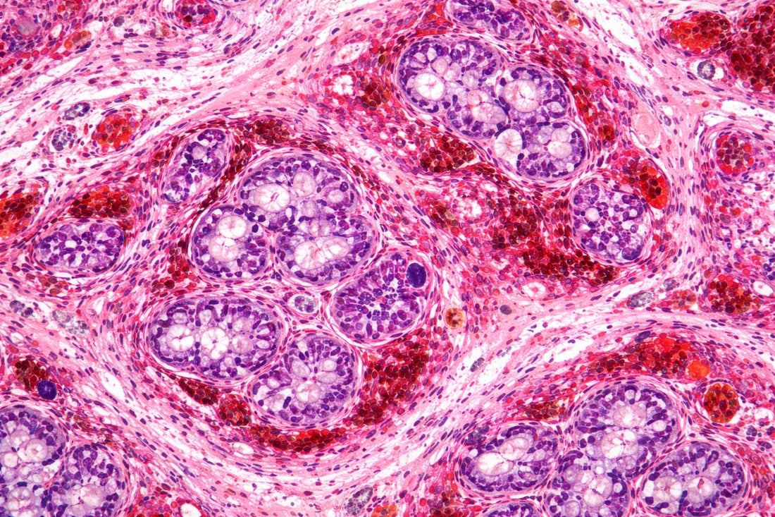 Understanding Endometriosis