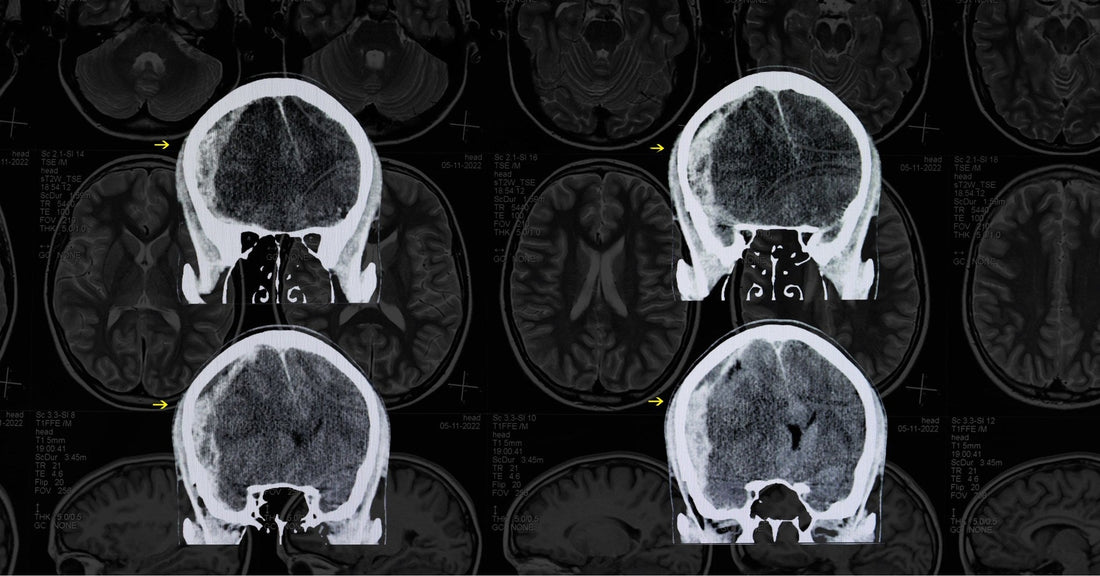 Progesterone Therapy & Traumatic Brain Injury